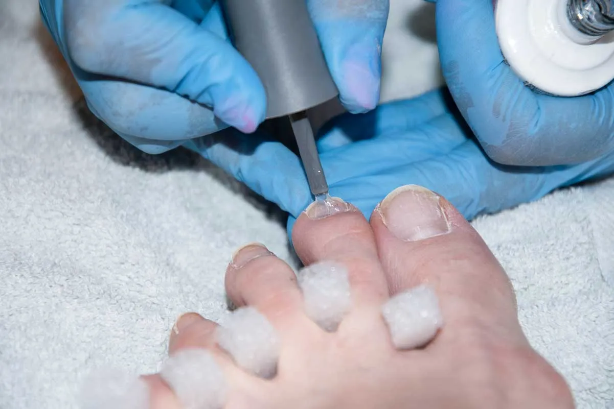 treatment for deformed nails